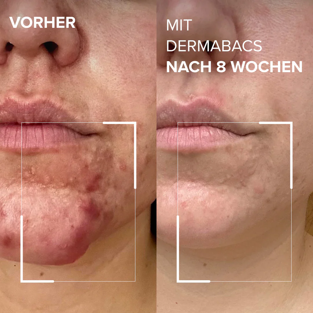 Dermabacs® - Image 3